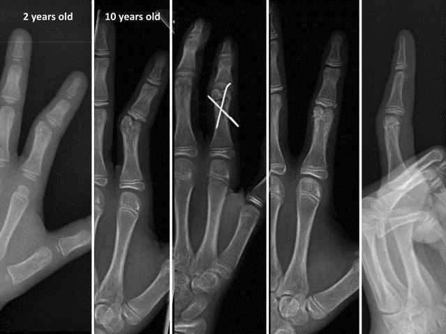Two-year-old girl with an unwitnessed injury to her left index finger. She presented 10 months later with an intracondylar proximal phalanx malunion.
