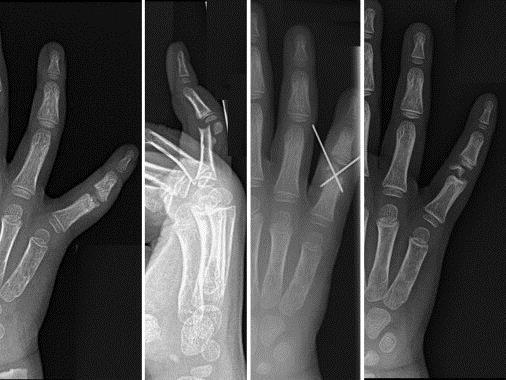 Three-year-old girl presented 2 weeks after right small finger injury. Radiographs show a small finger DCP fracture, with no bony contact (type III).