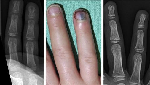 Six-year-old boy with middle and ring fingertip crush injury and a closed subungal hematoma on the ring finger.