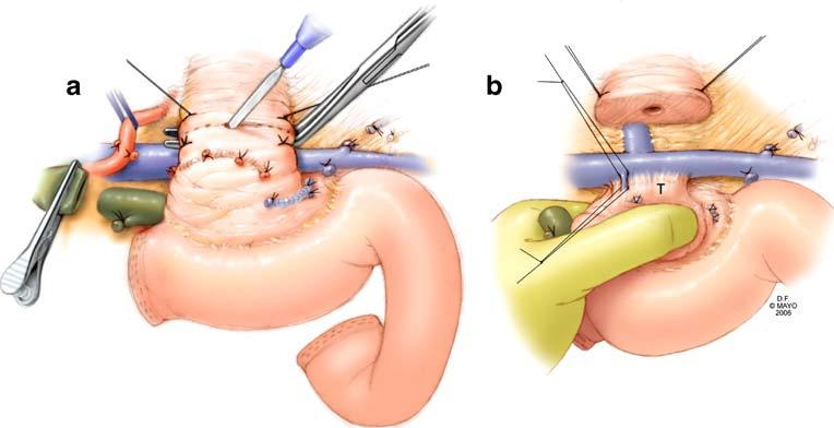 J Gastrointest Surg (2007) 11:425 431 427 Figure 2 a The neck of the pancreas is transected over a clamp, thereby, protecting the portal vein from injury.