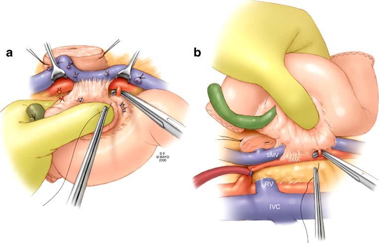 The mobilized duodenum and jejunum are passed beneath the superior mesenteric vessels into the right upper quadrant.