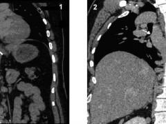 INTRODUCTION The recent development in cross sectional imaging and advanced radiological techniques is an asset in recognising the anomalies of IVC & its tributaries as an incidental finding in