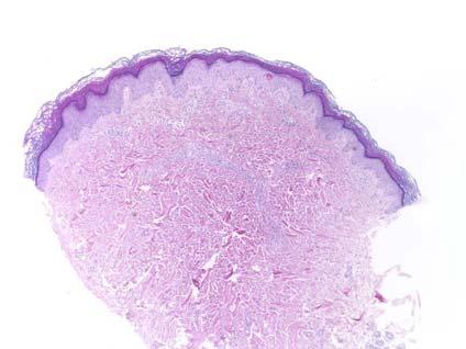 Case 2 55 yo man with disseminated anaplastic large T-cell