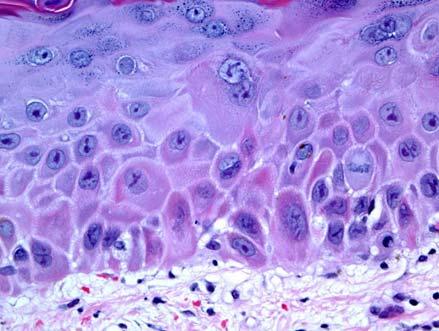 Starburst cell Diagnosis: Drug reaction, due to chemotherapy Ultraviolet enhancement/recall Chemotherapy reactions (dysmaturation) Clinically, variable (including acral erythema) Histologically,