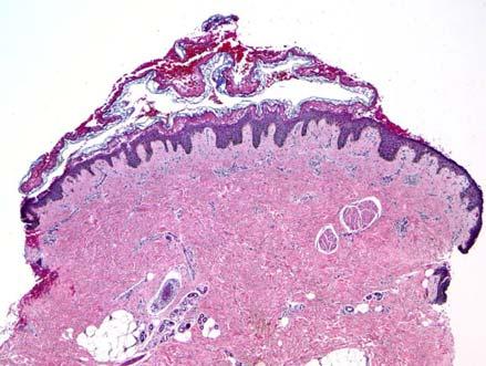 ) Psoriasiform lichenoid (syphilis) Suppurative Suppurative and