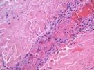 Thrombotic vasculopathy: Infectious Septic vasculitis Histologic findings can range from
