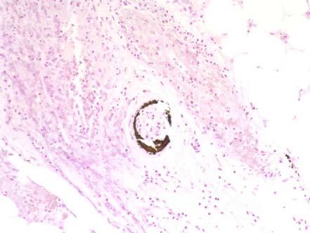 difficult to find the causative organism histologically: Meningococcemia: organisms