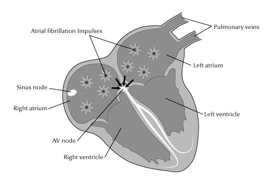 Figure 2 Atrial fibrillation may be paroxysmal or chronic. Paroxysmal atrial fibrillation refers to atrial fibrillation that comes and goes on its own.