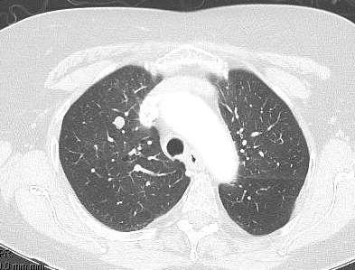 CT Chest There are numerous bilateral pulmonary nodules compatible with