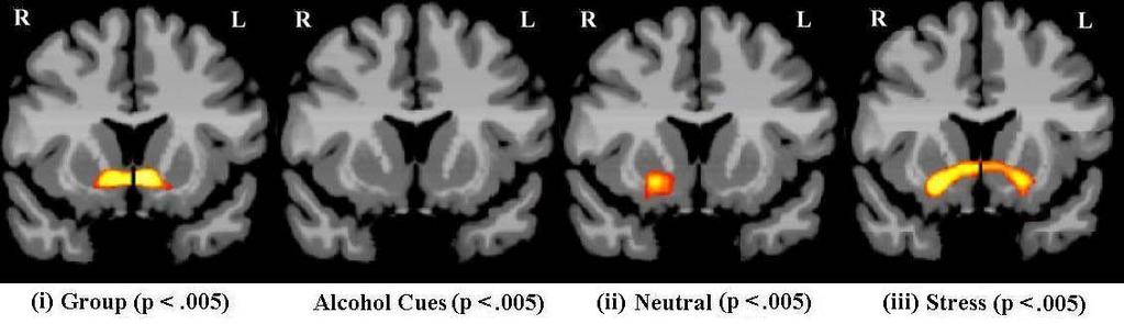 Neural Response to Stress in Healthy Adults with High vs Low Childhood Trauma Nucleus Accumbens/Striatum Individuals with greater childhood trauma (HR) showed greater