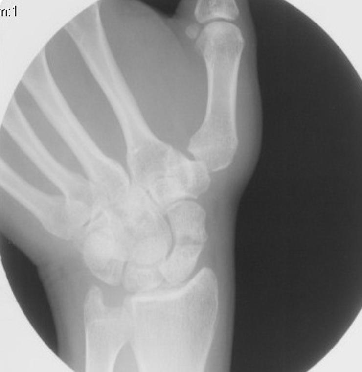 Figure 1. Radiograph of Case #1. Transverse fracture through waist of scaphoid occurring one year previously. No displacement or avascular necrosis is evident.