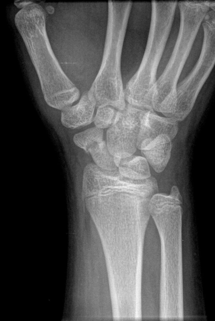 His motion was restricted in both flexion and extension. The waist of the scaphoid was non-tender, but the proximal pole near the scapho-lunate junction was tender.