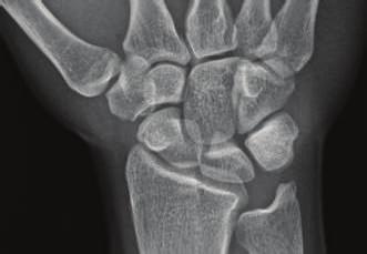 2 Case Reports in Orthopedics Figure 1: Posteroanterior radiographic view of the wrist at the time of initial evaluation that shows no abnormality in the scaphoid.