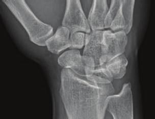 Figure 2: An oblique radiographic view at the time of initial evaluation without evidence of abnormality of the scaphoid.