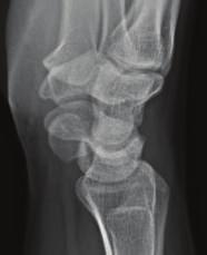 The patient was placed in a removable thumb spica wrist splint and was instructed to avoid any loaded extension of the wrist, including throwing the shot-put and weight-training.