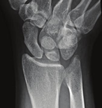 presentation. Figure 5: A scaphoid view obtained 6 after presentation without radiographic evidence of a scaphoid waist fracture.