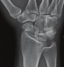 Figure 6: An oblique radiographic view obtained 6 after presentation with no radiographic abnormality of the scaphoid.