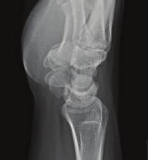 Several patients with negative presenting radiographs had the fracture only later diagnosed on repeat radiographs or advanced imaging [2, 3, 6].