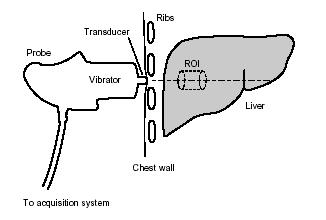 Transient Elastography: Liver Stiffness Measurement: Fibroscan R 1.- The probe induces an elastic wave trough the liver 2.