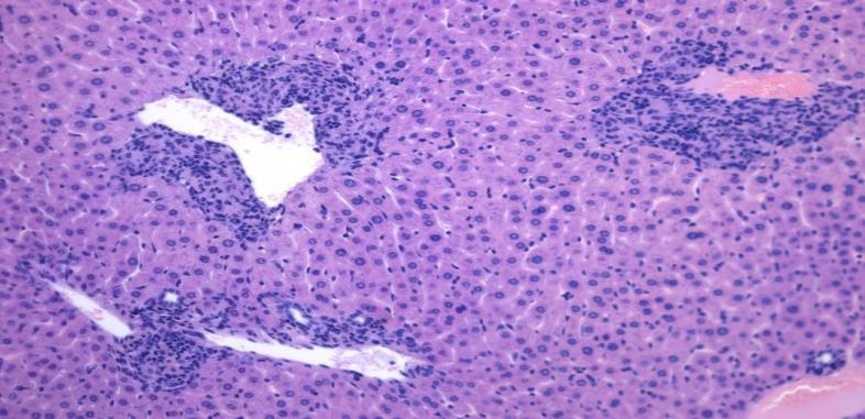 Liver Biopsy 1. - Provides clues about etiology and co-factors 2. - Allows immunohistochemical, biochemical biomolecular, genetic and epigenetic investigations 3.