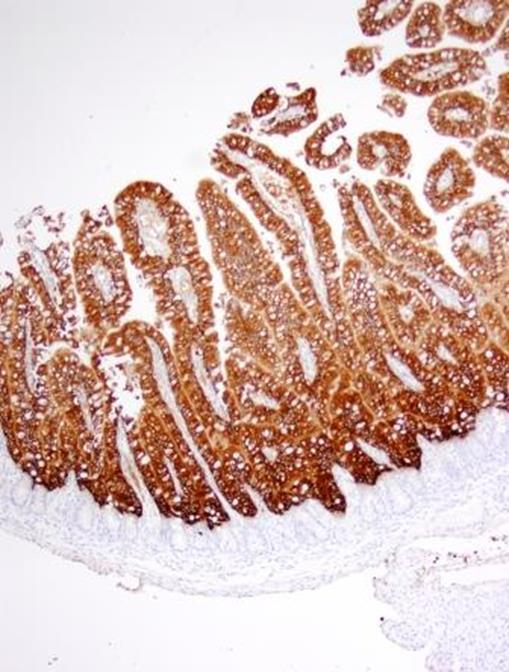 PED infection in a neonatal pig. The brown staining is infected cells lining the villi in a piglet roughly 8 hours after infection.