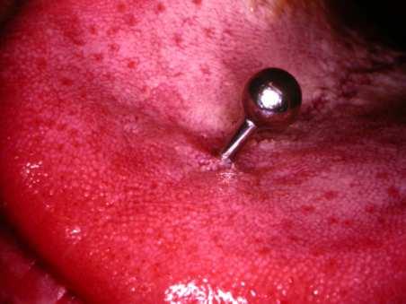Mild hyperkeratosis of the gingiva