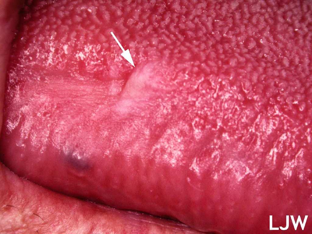 Mucosal scarring from