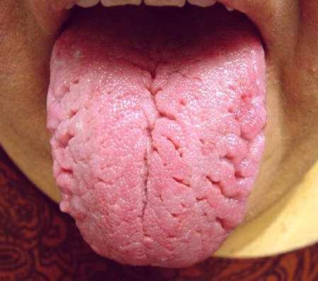 tongue Hairy tongue