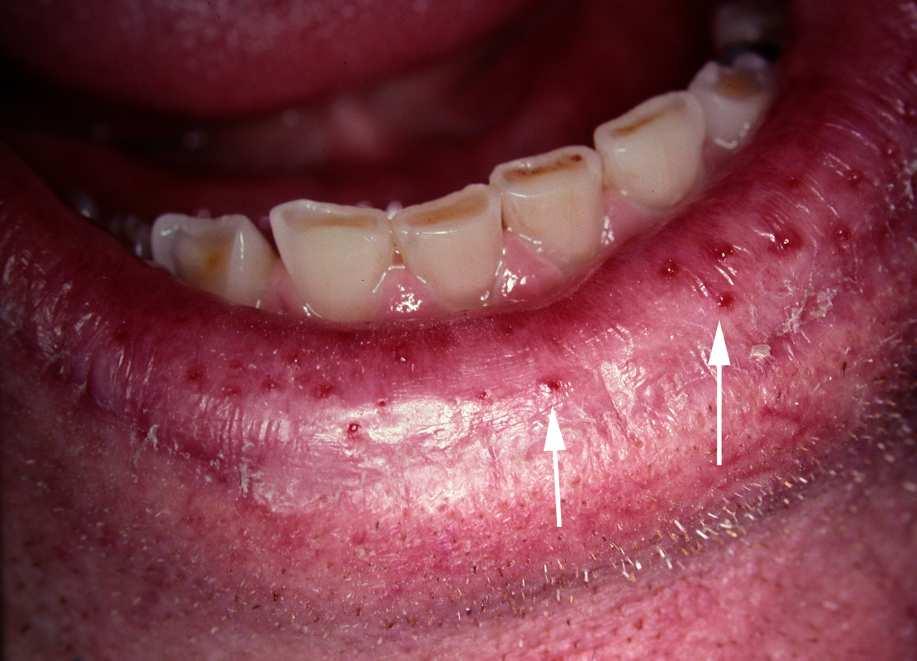 root surface caries