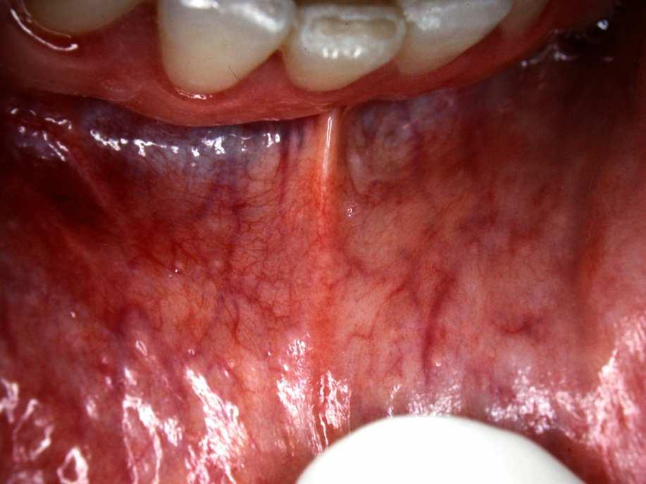 Minor salivary glands 1 per square cm