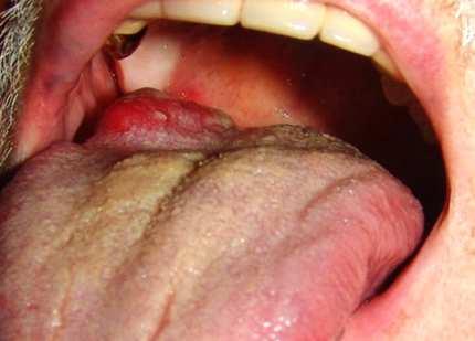 Oral cancer Oral cancer
