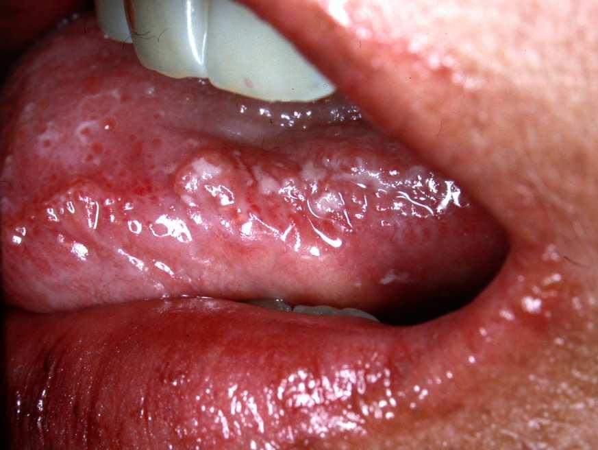 Infections Angular cheilitis