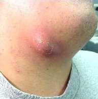cellulitis infection of the
