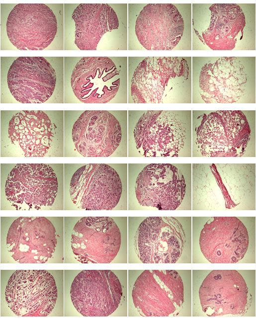 A712(18)- Test slide, Breast cancer tissues with corresponding normal tissues (formalin fixed) For research use only QC