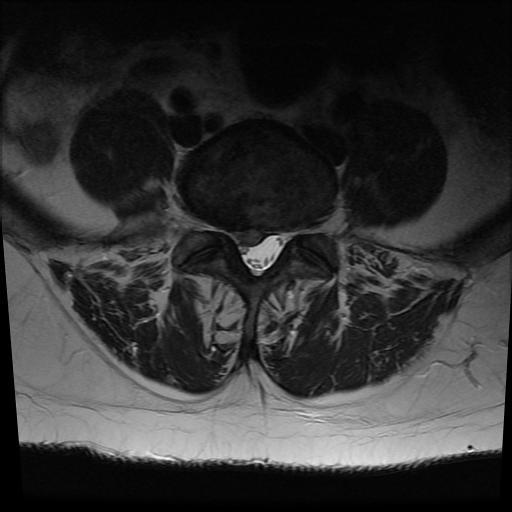 Clinical Example: Lumbar Disc Herniation Walters, Roxana F Page: 14 of 48 A P cm --- L Lumbar Disc Herniation is the most frequent indication for spinal surgery in the US 15-fold