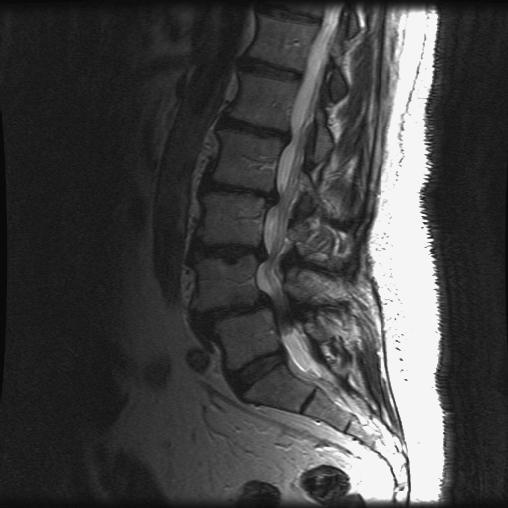 Clinical Example: Grade I Degenerative Spondylolisthesis Degenerative lumbar spinal stenosis - most frequent indication for spinal surgery in