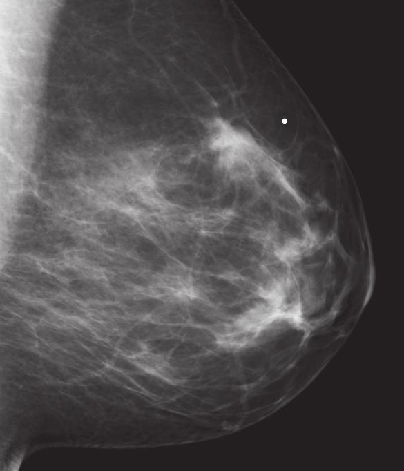 If a cancer is found, these are often smaller and more curable. The radiologists utilize Computer-Aided Detection (CAD) as a tool to enhance the information provided in mammogram images.