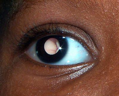 Retinoblastoma Leukocoria Most common intraocular