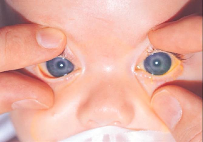 Big, Watering Eye Congenital/infantile glaucoma Globe enlargement Sclera elastic in infants Myopic
