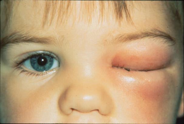 Orbital Cellulitis In children, can worsen rapidly Complications Sight loss Abscess