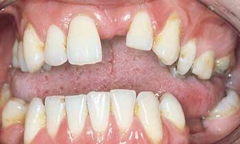 () This ptient s mxillry lterl incisors hd never developed nd she ws concerned out the spcing of the nterior teeth.
