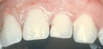 The reduced spce does not llow for n rtificil tooth of relistic size to e used on denture.