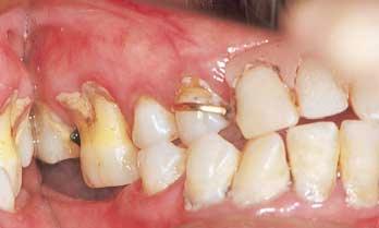 ction of the remining teeth. An RPD will prevent this escpe of the olus nd thus contriute to efficient mstiction.