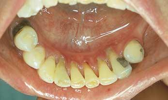 () The lingul plte is well supported on the nturl teeth nd fits well ginst tooth surfces.