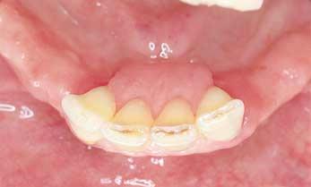 It hs cused resorption of the one to such n extent tht the lingul r connector hs een pushed down towrds the floor of the mouth.