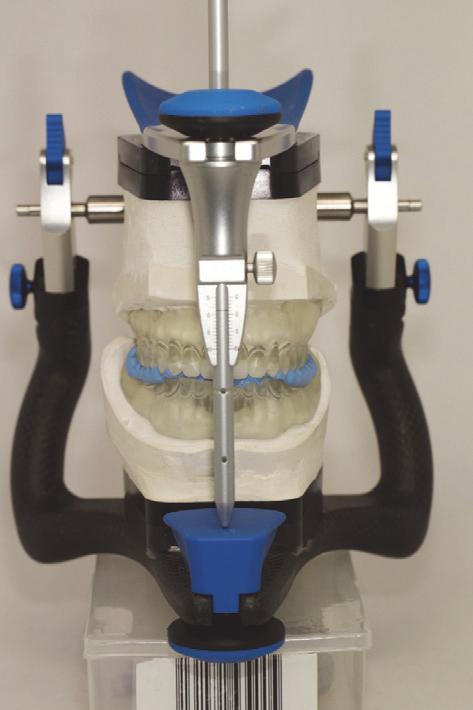 The conventional denture teeth (Heraeus Kulzer GmbH, Germany) were modified according to the individual clinical situation.