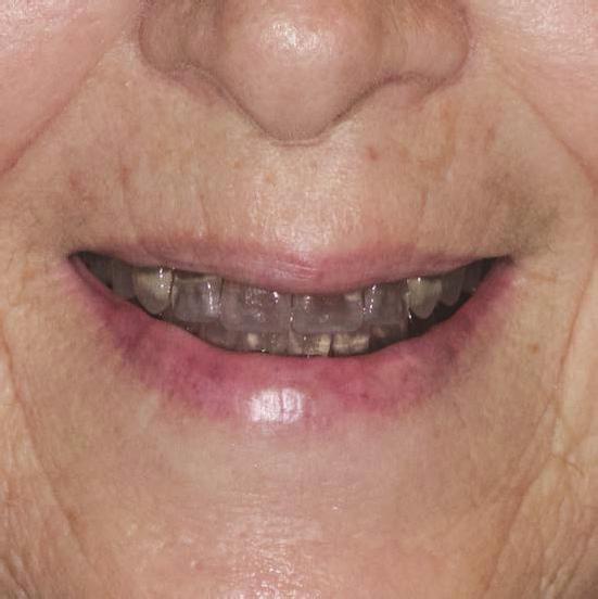 The teeth were bonded in the milled sockets of the denture base by mechanic retention done in the milling of the denture