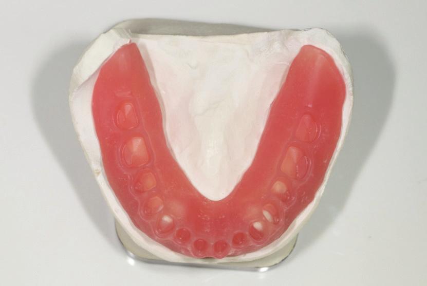 Discussion In the past few years, significant advancements have taken place in the fabrication of complete dentures with the introduction of CAD/CAM technologies.