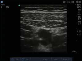 dependent on the method used to identify the nerve High frequency transducer Short-axis image, needle inserted in-plane Saphenous nerve is a