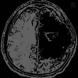43 Figure 7 Resized Gray Scale Image cluster No.1 2. Selecting Segmented Image- In a tumor affected brain, tumor is bright in color as compared to its surrounding.